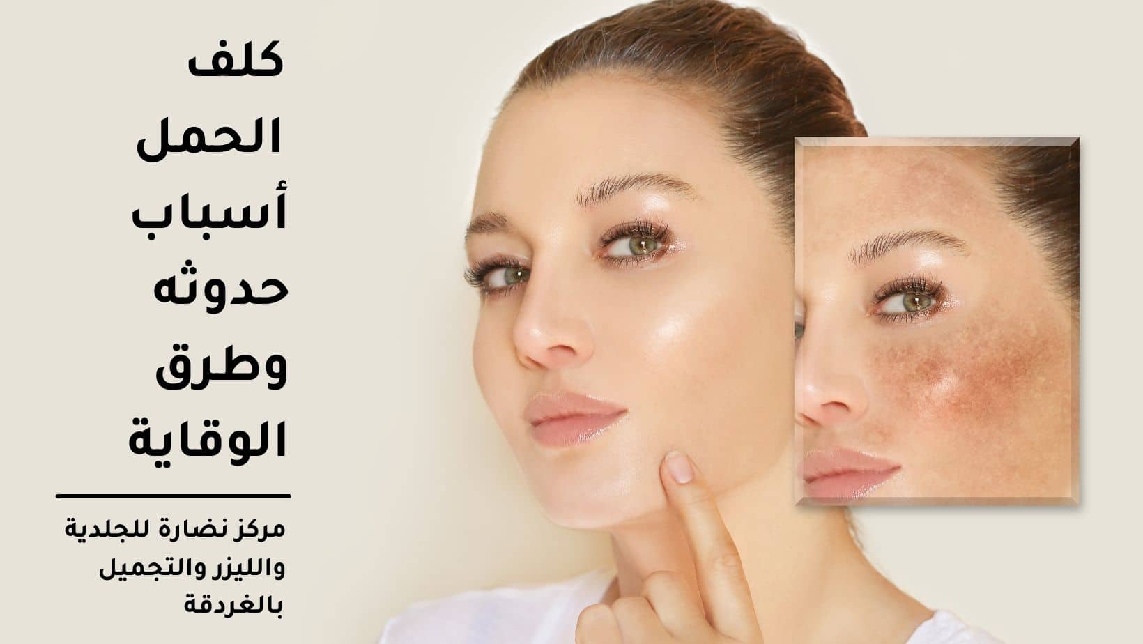 كلف الحمل أسباب حدوثه وطرق الوقاية